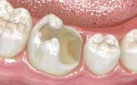 everx Posterior TM Benefit from an easy 4 mm layer application CLASS I CAVITIES CLASS II AND LARGE CAVITIES 1. Prepare cavity 2. Bond and light-cure 3a.
