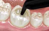 Direct composite resin restoration of an anterior tooth: effect of fiber-reinforced composite substructure. Garoushi S. Et al; Eur J Prosthodont Restor Dent 2007; 15:61 66. 3.