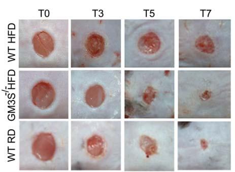 Paller Has Shown GM3S Depletion Increases Rate of Wound Healing Diabetic GM3 synthase deficient mice show a dramatic reversal of the wound healing impairment seen in their wild type diabetic