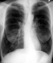 COPD Breathing Made Easier Catherine E.