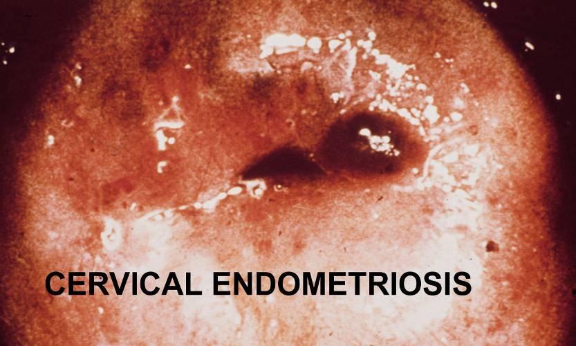 Cervical Endometriosis.