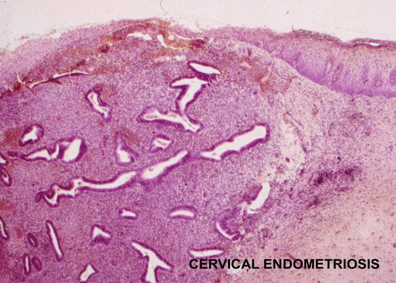 endometriosis: a continuing