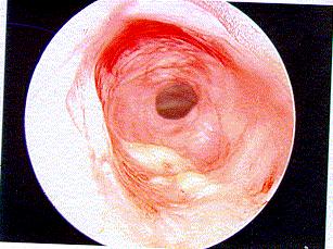 When? Incidence: of subglottic stenosis following intubation varies with