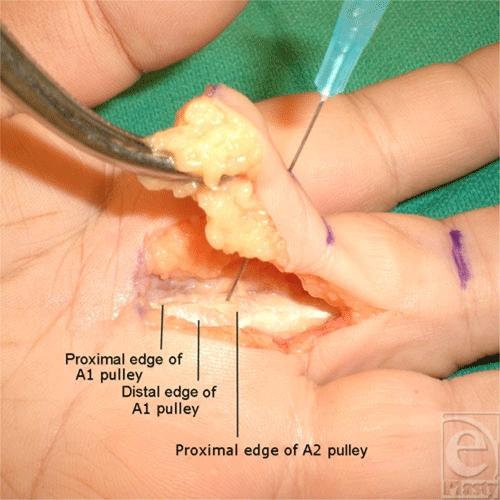 Figure 3. Sharp division of the A1 pulley extending to the percutaneous needle. Care must be taken when attempting percutaneous release of the border fingers.