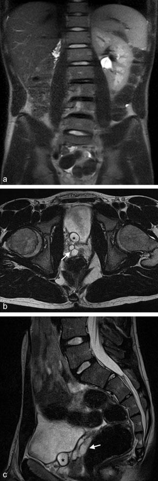100 Congenital Seminal Vesicle Cyst and Ipsilateral Renal Agenesis Kanavaki et al. Fig. 2 MRI at the age of 15 years. (a) T2 coronal images of the abdomen show right renal agenesis.