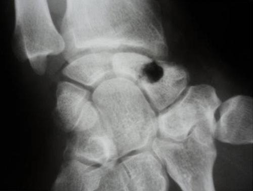 speckled calcification Figure 3: per operative radiograph