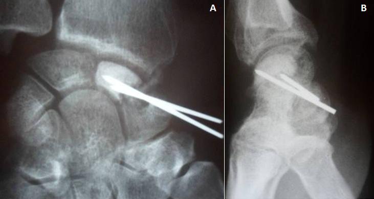 Figure 4: (A) Anteroposterior radiograph shows vascularized bone graft fixed by