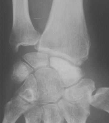 kirschner wires Figure 5: anteroposterior radiograph at 4-year follow-up