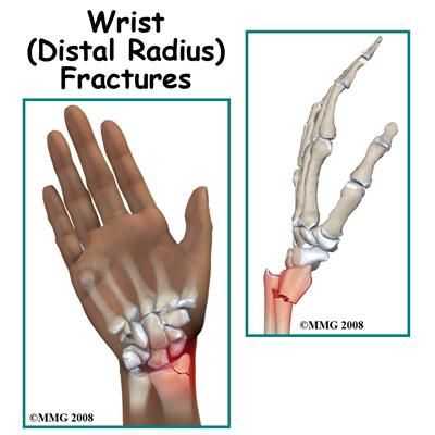 The edge of the distal radius also articulates with the ulna (the other bone that makes up the forearm) and forms a joint called the Distal RadioUlnar Joint (DRUJ).