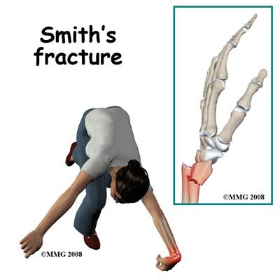 reduced (or manipulated) to a stable alignment without surgery and held with a cast or brace until it heals; or 3) surgery will be necessary to align the fracture fragments and fix the fragments with