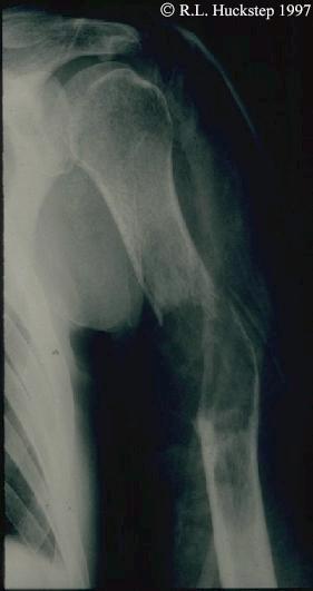 Pathological fracture due to a secondary deposit in the mid shaft of the humerus