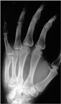 Acute ulnar collateral