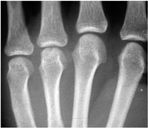 Beware of the proximal interphalangeal joint Fight bite Volar plate injury Boutonierre