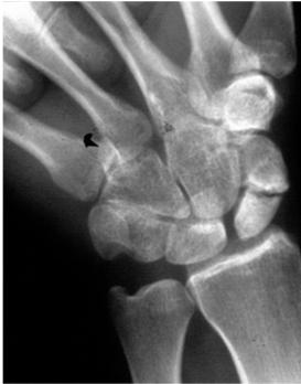 The sprained wrist that isn t Fractured scaphoid Scapho-lunate instability Dislocation of the lunate Fracture of the hook of the hamate Dislocation of the distal radio-ulna