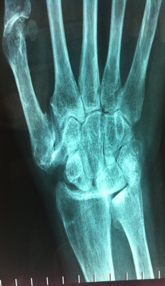 Primary osteoarthritis of the wrist relatively uncommon More commonly