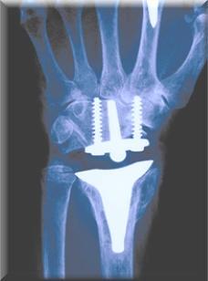 Wrist Arthroplasty Old low demand Not normal range of