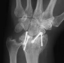 Limited Wrist Fusions Require intact midcarpal joint