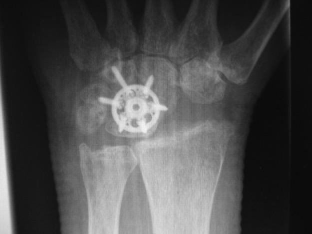 Case 2 47yo RHD male Wanted to preserve motion, grip strength Had 4