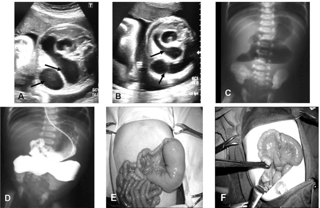 208 Imaging of Neonatal Upper Gastro-Intestinal Atresia Beyond the Esophagus The examination was started from the stomach to follow-up the pylorus, duodenum and evaluate their size.