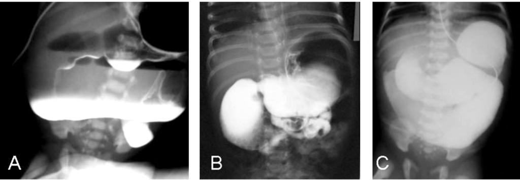 Fig. (1). The findings were polyhydramnios (5 cases), persistently dilated bowel loops on serial sonograms (5 cases). Table (2): Ultrasonography findings in examined neonates.