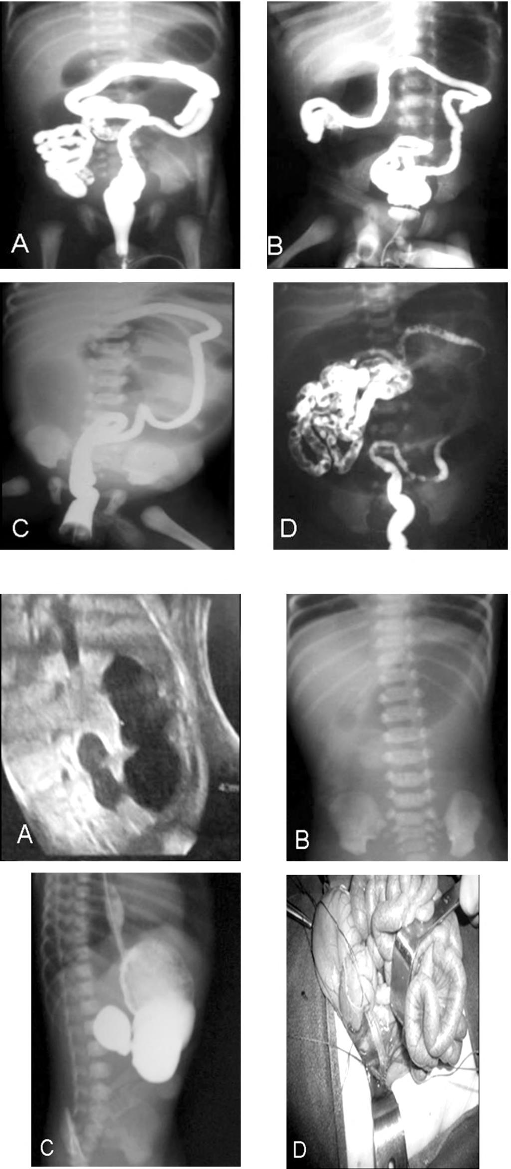 210 Imaging of Neonatal Upper Gastro-Intestinal Atresia Beyond the Esophagus For cases with jejuno-ileal atresia, primary anastomosis was used in all cases aimed to minimize bowel loss with sequences