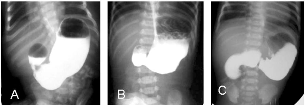 Mohammed Zaki & Ahmed M.A. Gafar 211 Prenatal diagnoses of duodenal atresia were reported in 2 cases in our series. The prenatal images were similar to the double-bubble sign Fig. (5).