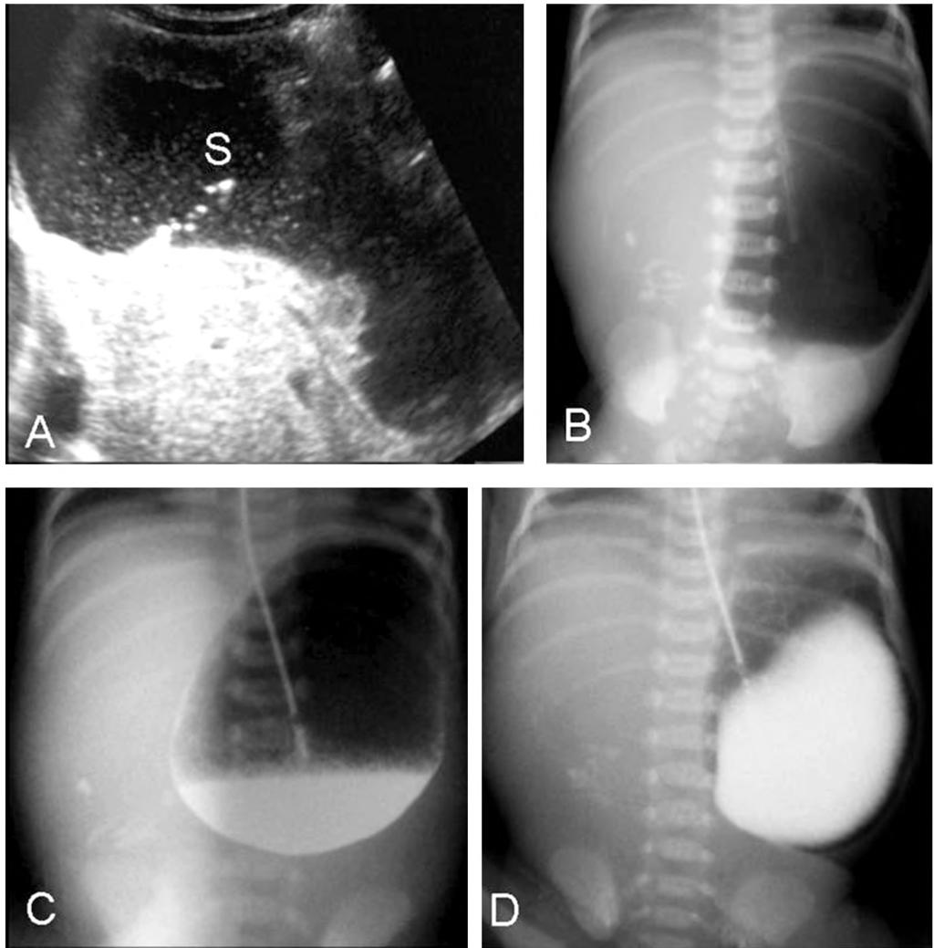 All neonates with of duodenal atresia were diagnosed by the pathognomonic double bubble sign with gasless distal bowel in plain abdominal erect X- Ray.