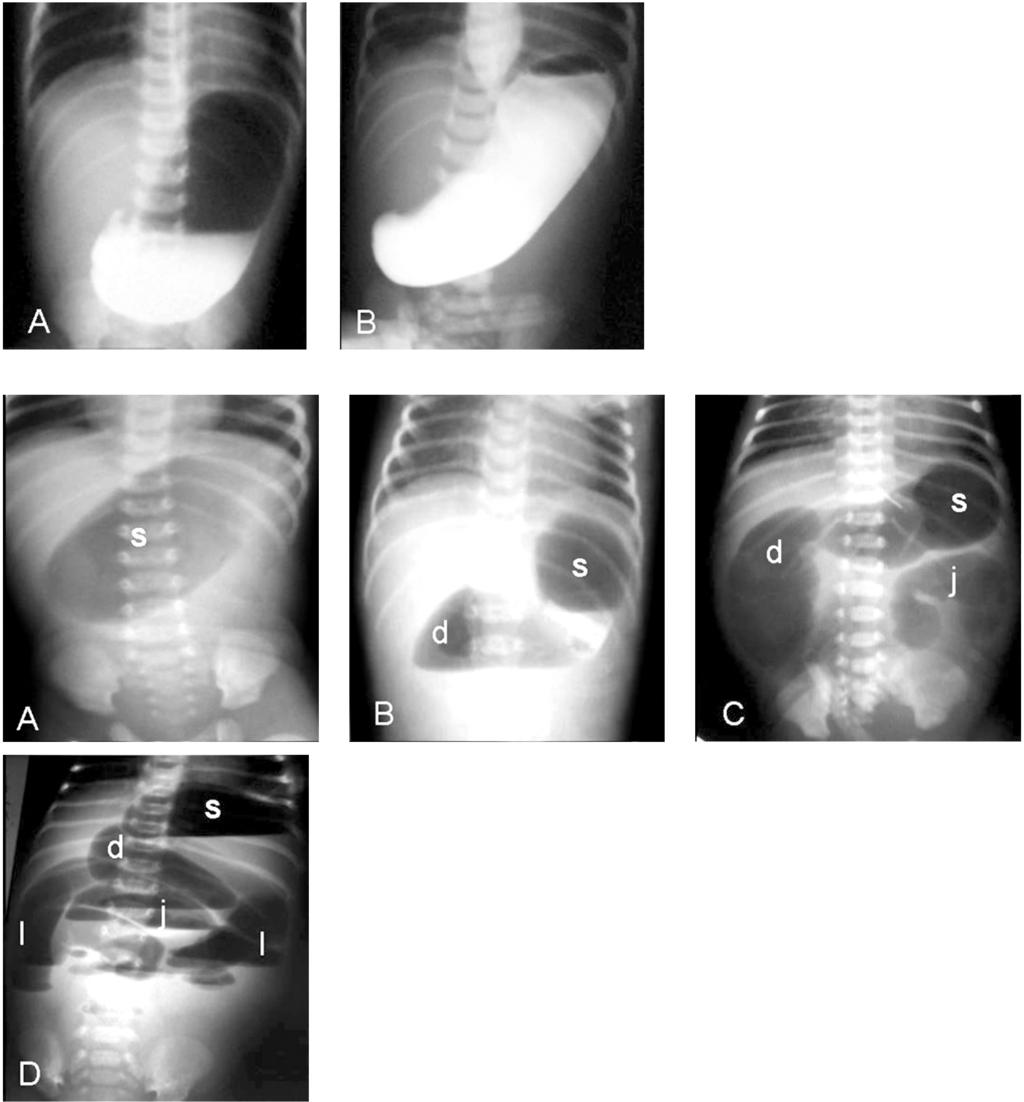 212 Imaging of Neonatal Upper Gastro-Intestinal Atresia Beyond the Esophagus Fig. (8): (A, B) Contrast examinations of two different neonates with pyloric atresia. The stomach is markedly dilated.