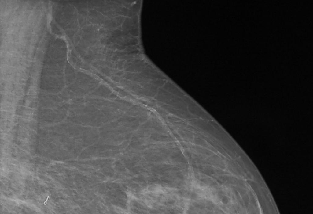 Mammographic Response in Invasive