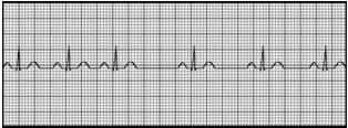 A common length of an ECG printout is 6 seconds; this is known as a