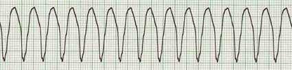 Abnormal ECG Ventricular tachycardia