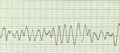 Abnormal ECG Ventricular fibrillation Unco-ordinated electrical