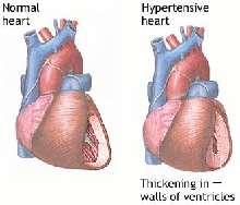 Hypertension High blood pressure is