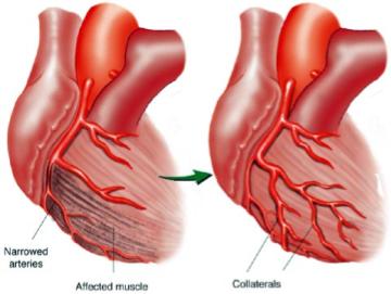 Problems with blood flow to heart muscle angina pectoris chest pain due to lack