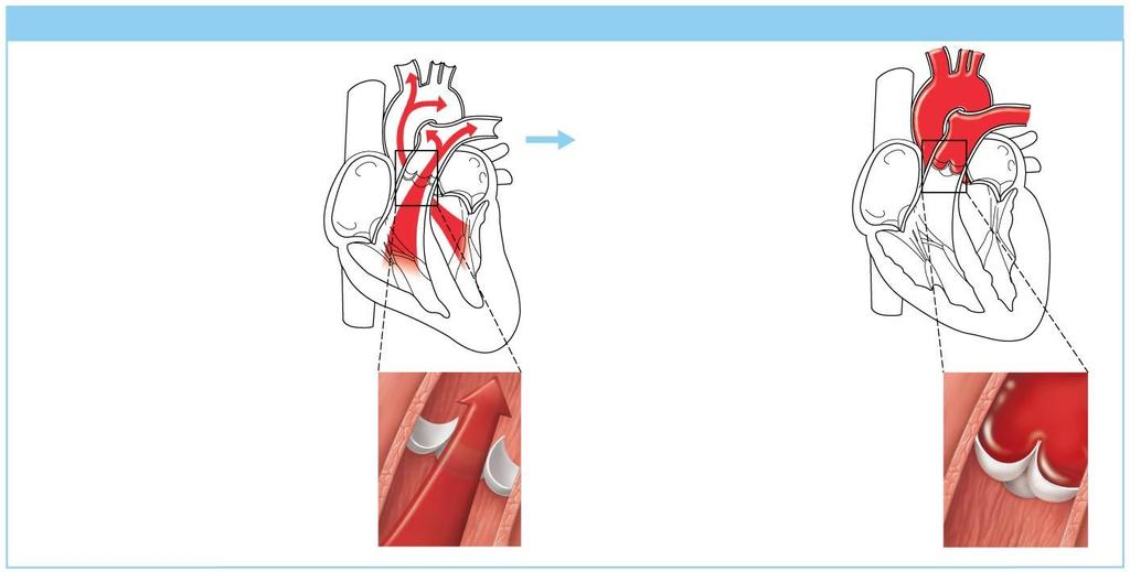 Figure 11.6b Operation of the heart valves.