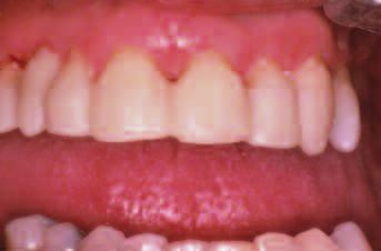 periodontitis, or pocket formtion.