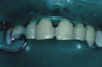 occlusion, or comintion thereof. Tooth moility is reported during periodontl chrting, often using the Miller Index.