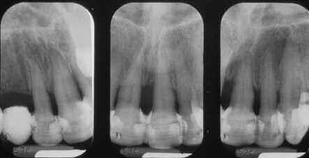 1,10,11,24-26 Currently, it is generlly ccepted tht tooth moility is n importnt clinicl prmeter in predicting periodontl prognosis of those teeth.