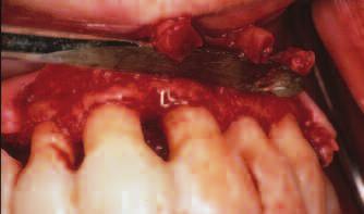 of moile teeth. 28 Further, regenertive procedures using memrnes nd one grft hve greter predictility if tooth movement is eliminted.
