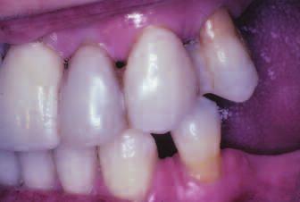 One fculty memer hd suggested n immedite mxillry denture sed upon the ptient s periodontl sttus nd finncil limittions. The ptient rejected the ide of extrcting the mxillry teeth.