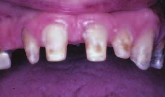 Periodontl nd occlusl trum DENTALCETODAY.COM SEPTEMBER 2009 Tle. Clinicl findings mxillry rch April 7, 1997 c Missing: Nos.