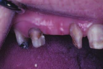 9 Furction involvement: No. 12 Infrony Defects: Nos. 4-D; No.5-D; No.9-M; No.10-M Prognosis mxill: 3 to 5 yers gurded Adult moderte periodontitis Posterior ite collpse Primry occlusl trum Figure 10.