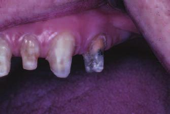 Due to finncil considertions, the tretment pln for n occlusl djustment nd the plcement of fier splint ws sed upon the ptient s desire to not hve removle prtil denture to provide for posterior support.