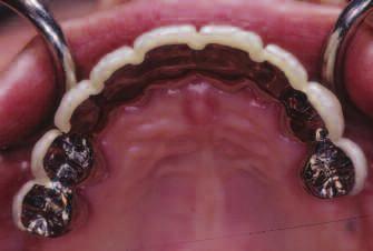 The ptient hd n esthetic complint of drk tringles in the gingivl emrsures of the mxillry nterior teeth. The decision ws to plce porcelin veneers on Nos. 6 to 11.
