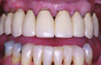 The veneers (Cerinte Porcelin Veneers, Den-Mt) were fricted nd pid for with reserch ccount. The ptient ws plced on 3- to 4-month periodontl mintennce recll schedule.