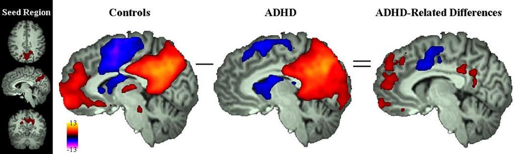 Adult ADHD: Decreased Positive Correlations In Default-Mode Network Between PCC-MPFC 20 ADHD participants (mean