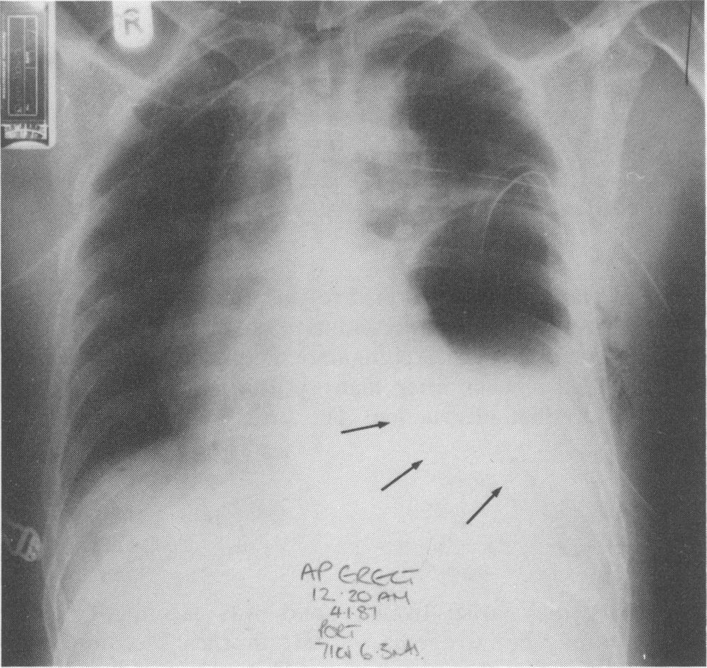 318 CLINICAL REPORTS Figure 1 Case 1. Portable chest X-ray showing two drains in the left hemithorax, with a curvilinear shadow below the drains.