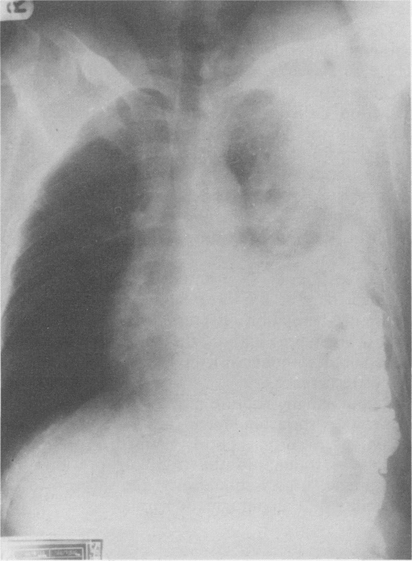 chest. Barium follow-through studies demonstrated colon in the left chest (Figure 2). His diaphragmatic hernia was repaired through a left thoracoabdominal approach.