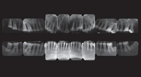 The periodontl chrt ws completed nd set of peripicl rdiogrphs ws performed in order to determine the prognosis of the teeth in the mxill nd in the mndile.