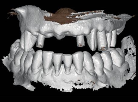 The im of the uxiliry scn ws to provide the dentl lortory technicin with informtion regrding the functionlized provisionl prosthesis, such s the incisl edge
